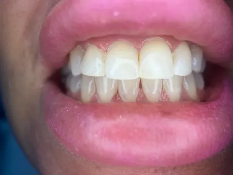 Teeth straightening in Bodrum, Turkey — after