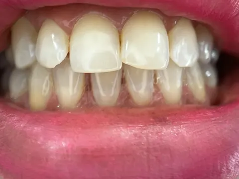Teeth straightening in Bodrum, Turkey — before