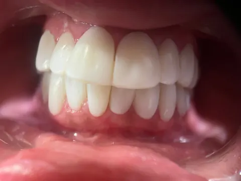 Teeth whitening in Bodrum, Turkey — after