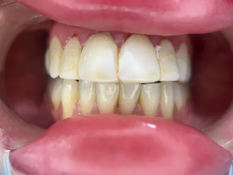 Teeth whitening in Bodrum, Turkey — before
