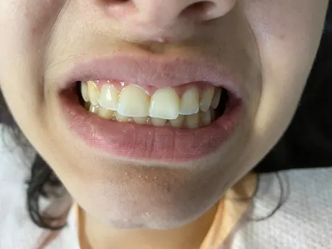 Composite bonding in Bodrum, Turkey — after