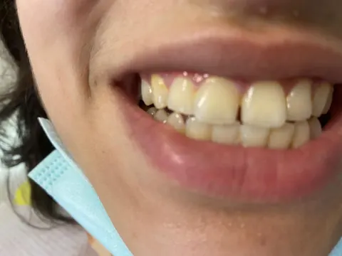 Composite bonding in Bodrum, Turkey — before