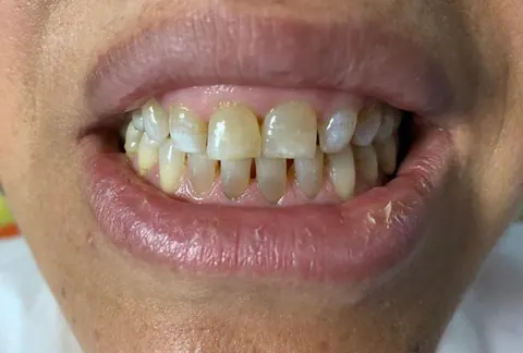 Gummy smile correction in Bodrum, Turkey — before
