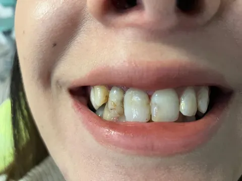 Smile design in Bodrum, Turkey — before