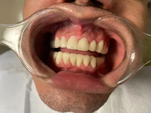 Zirconium crowns in Bodrum, Turkey — after