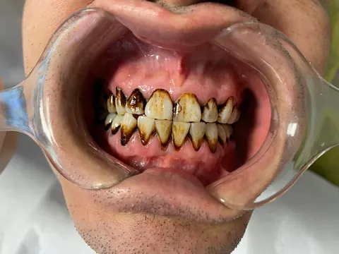 Zirconium crowns in Bodrum, Turkey — before