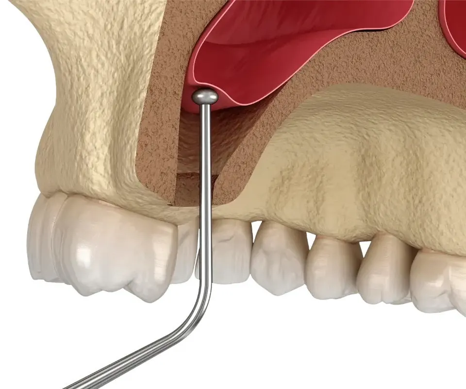 Bone graft and sinus lifting in Bodrum, Turkey