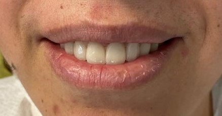 Gummy smile correction in Bodrum, Turkey — after