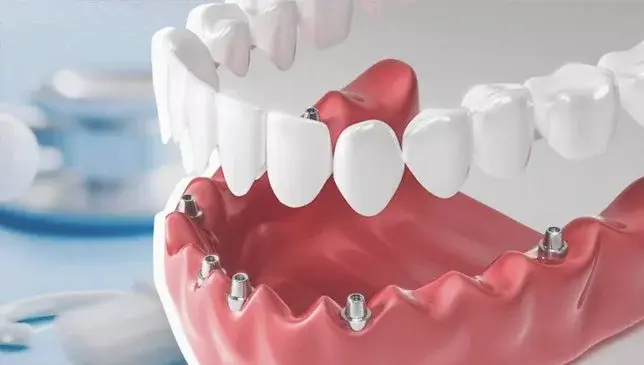 Prosthesis over denture in Bodrum, Turkey